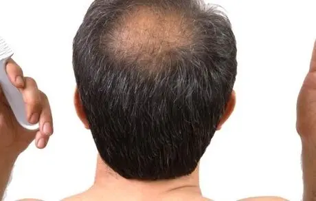 اگر می خواهید کچل نشوید این غذاها را بخورید