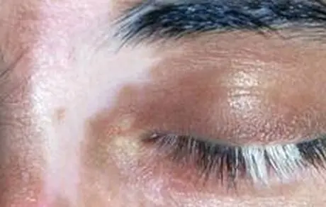 بیماری پوستی که در یک قدمی شماست