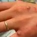 انگلستان در حال  انبار کردن واکسن آبله