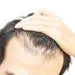 ۱۱ نکته برای جلوگیری از ریزش مو