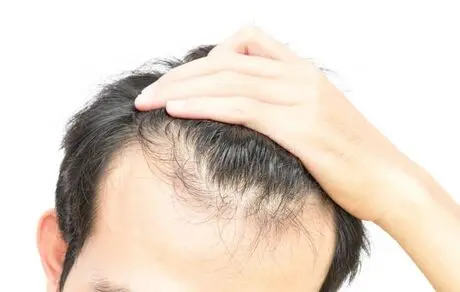 ۱۱ نکته برای جلوگیری از ریزش مو