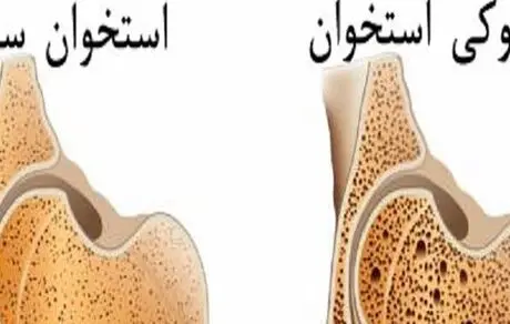 هشدار درباره پوکی استخوان در مردان 