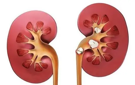 تکنیک‌هایی طلایی برای پیشگیری از سنگ کلیه