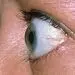 چرا چشم‌ها از حدقه بیرون می‌زند؟