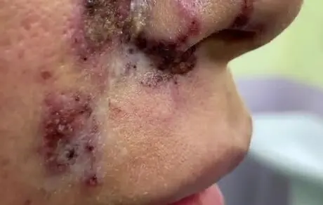 ویدیویی از عفونت در محل تزریق ژل صورت
