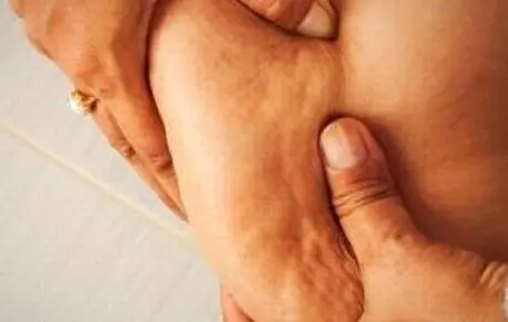 عارضه شایع چاقی