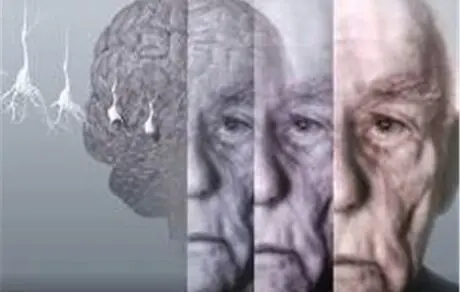 چربی‌های ترانسی که باعث ابتلا به آلزایمر می‌شود