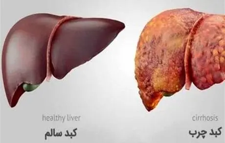 شیوع دو برابری کبد چرب در کشور