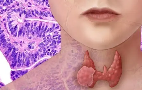 همه چیز درباره سرطان تیروئید و راه درمانش