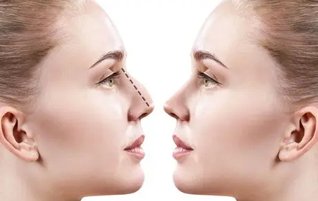 حداقل سن عمل زیبایی بینی