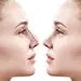 حداقل سن عمل زیبایی بینی
