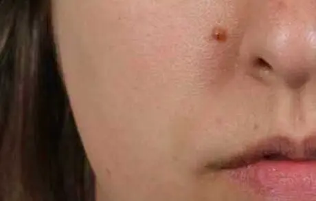 علل ایجاد خال گوشتی بر روی پوست +معرفی انواع آن