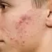 ۷ بیماری پوستی که با جوش اشتباه میگیریم + تصاویر