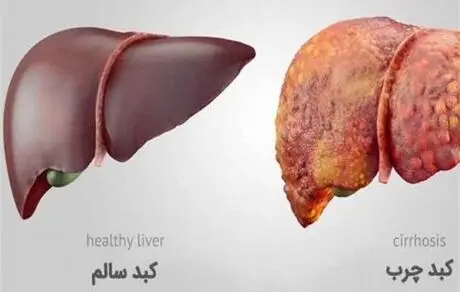 کبد چرب قابل کنترل است!