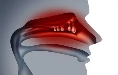 کسانی که پولیپ بینی دارند، بخوانند!