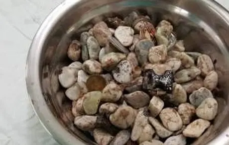 خارج کردن یک کاسه سنگ و فلز از شکم بیمار + عکس