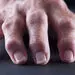 درد آرتروز انگشتان خود را چگونه کم کنیم؟