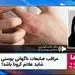  علائم جدید کرونا روی پوست صورتتان!
