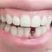 با عوارض ایمپلنت دندان آشنا شوید