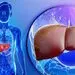 افزایش بیش از حد آهن عامل بیماری‌های کبد و اضافه‌وزن است