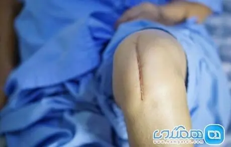 نکات مهم درباره عمل زانو 