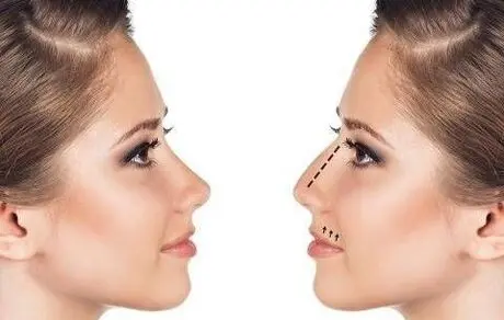 10 روزه در خانه بینی خود را کوچک کنید!
