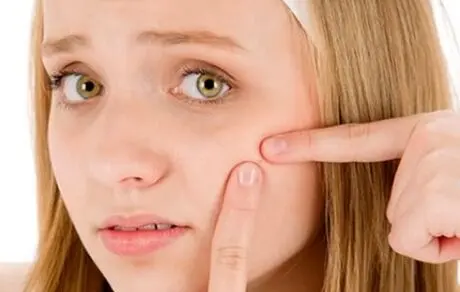 خانم ها، برای مقابله با جوش می توانید این مواد غذایی را میل کنید