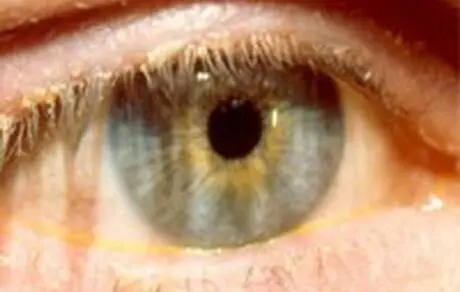چشم‌ها از کشنده‌ترین بیماری‌ها خبر می‌دهند
