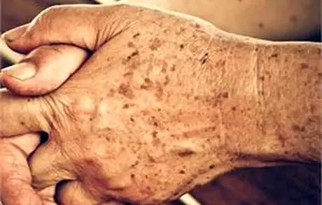 لکه‌های پوستی از کجا می‌آیند؟ + دلایل