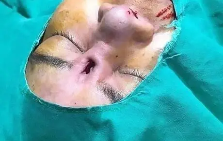 جراحی زیبایی بینی چهره این دختر را وحشتناک کرد