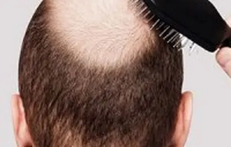 راه های تقویت رشد مو+ علل ریزش