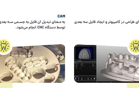 ایمپلنت دیجیتال چیست و چه کاربردی دارد