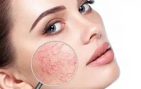 داشتن گونه های قرمز نشانه چیست؟