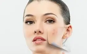روش هایی برای رهایی از لکه‌ های پوستی