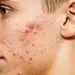 6 غذا که باعث ایجاد آکنه میشوند