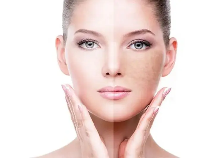 رفع تیرگی زانو و آرنج در ۷ روز  + ویدیو