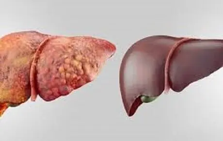خوراکی هایی که باعث گرمی کبد میشوند+روش درمان