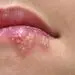 چگونه از انتشار تبخال جلوگیری کنیم؟