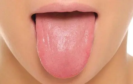چه چیزی موجب بروز لکه های سفید و گرد روی زبان می شود؟