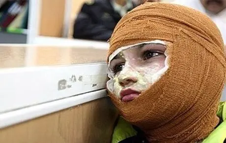 هزینه درمان سوختگی چقدر است؟