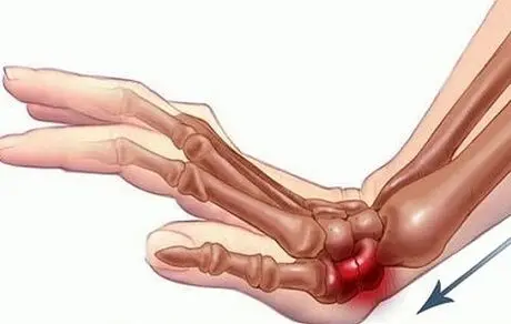 شایع‌ترین شکستگی در زنان بالای ۴۰ سال