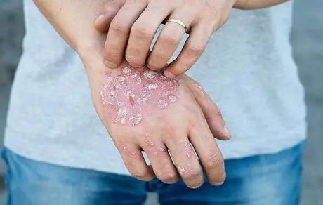 نسخه ای برای سوریازیس 