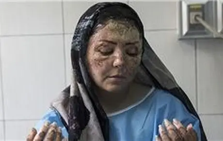 اسید پاشی انتقامی دردناک از نگارهای بیگناه!