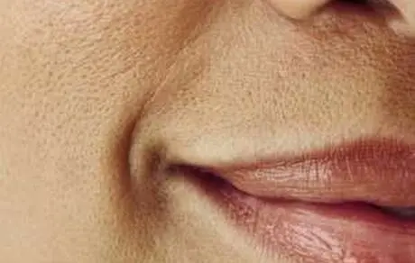 با منافذ پوستی باز چه کنیم؟