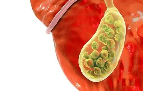 سنگ کیسه صفرا چگونه به وجود می‌آید؟