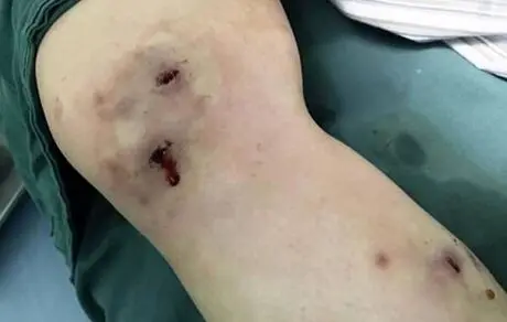 وحشت یک دختر از خروج کرم از زیر پوستش!+ عکس