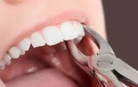 این دلایل خبر می دهند که باید دندانتان را بکشید