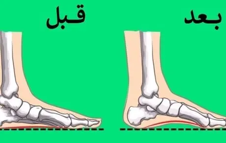 کاهش مشکل صافی کف پا با چند تمرین ساده