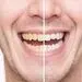 چگونه دندان های خود را به صورت طبیعی سفید کنیم ؟ 