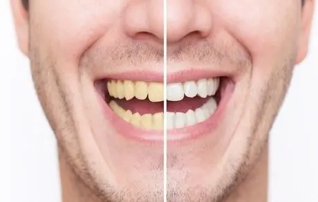 چگونه دندان های خود را به صورت طبیعی سفید کنیم ؟ 